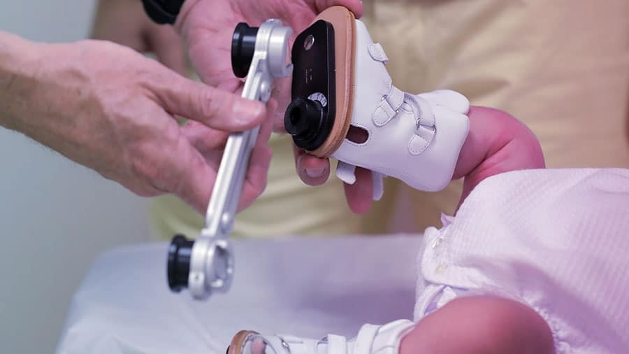 Progresión corrección con yesos Ponseti